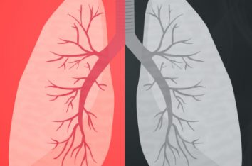 Feingold Medical Legal - Lung Cancer Risk for Non-Smokers